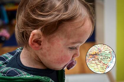 Las autoridades sanitarias de Nueva Jersey alertaron a la población sobre un caso de sarampión; el 90% de las personas no vacunadas se contagian de esta enfermedad