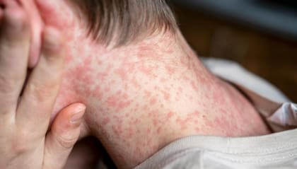 Las autoridades sanitarias rastrean a 130 menores expuestos al virus en un centro educativo en Sacramento