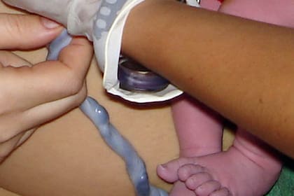 Las células madre de cordón umbilical empiezan a ser valoradas en la Argentina