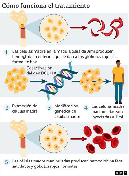 Las células madre de Jimi se enviaron a los laboratorios Vertex Pharmaceuticals, donde se llevaría a cabo la edición genética