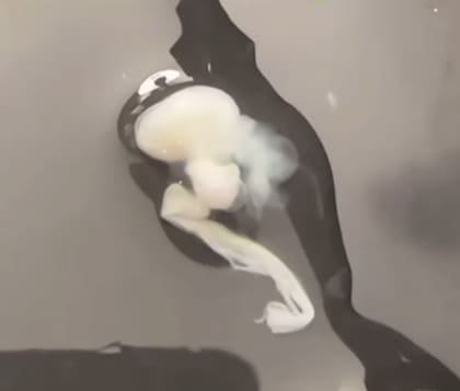 Las diferentes formas en las que puede aparecer la chalaza (Foto: Captura Instagram @miguel_assal)