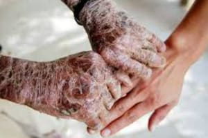 Más del 70% de los pacientes recurrió a ahorros o pidió ayuda para su tratamiento