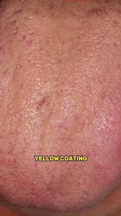 Las grietas en la lengua serían un indicio de que no deberías tomar café según el doctor Khalaf