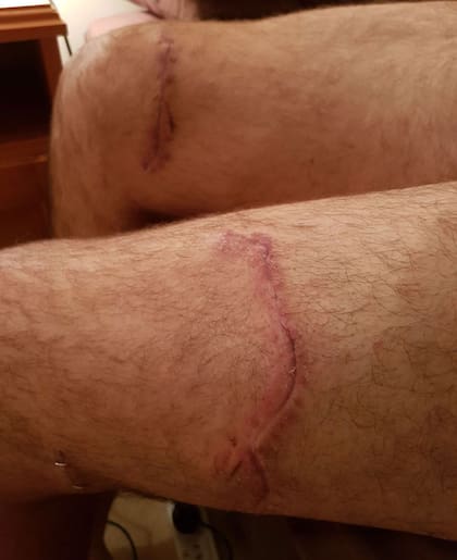 Las heridas de Alejandro Travaglini