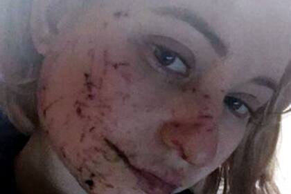 Las heridas de Tania estaban claramente visibles cuando tomó esta foto dos días después del bombardeo.