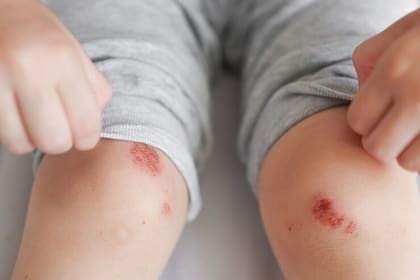 Las heridas generan un campo eléctrico para ayudar a su sanación