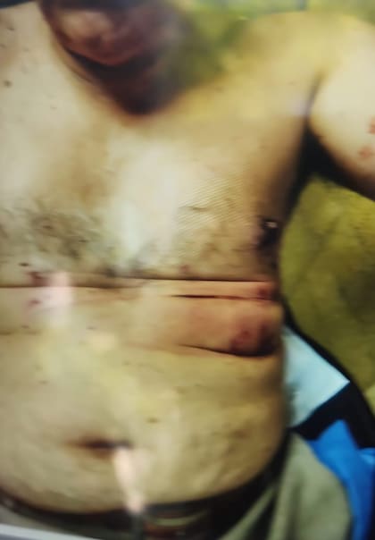 Las heridas tras la explosión