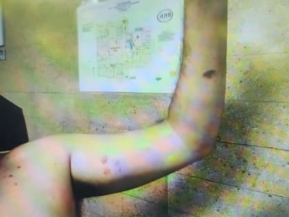 Las heridas tras la explosión