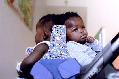 Las hermanas gemelas Ervina y Prefina antes de su operación