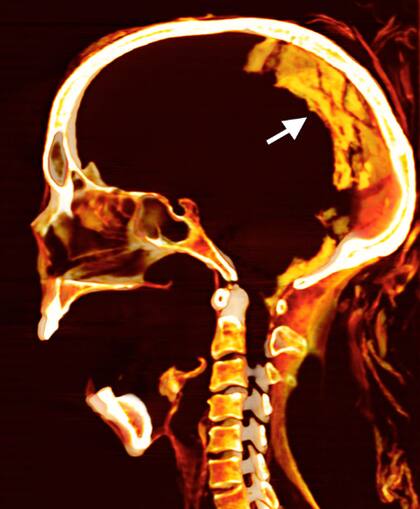 Las imágenes también mostraron una lámina cribiforme intacta, con el cerebro disecado y preservado descansando en la parte posterior del cráneo (flecha)