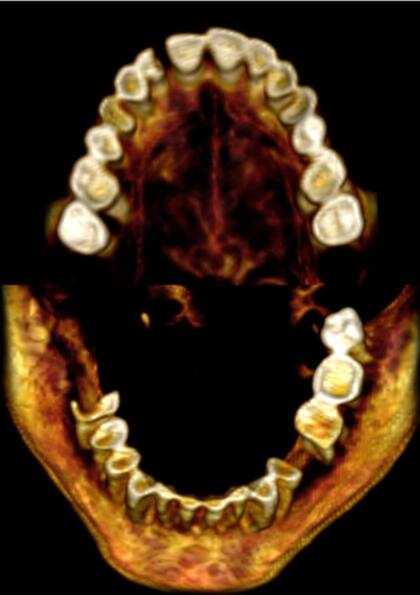 Las imágenes tridimensionales de TC del maxilar y la mandíbula dejan ver los dientes de esta mujer momificada que muestran que faltaban algunos dientes durante la vida
