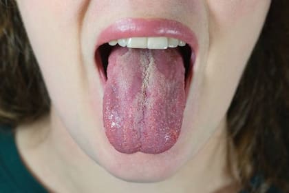 Las lenguas blancas, agrietadas o muy rojas podrían indicar falta de vitaminas y minerales, al igual que problemas hepáticos