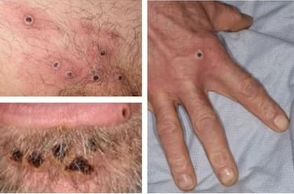 Las lesiones en la piel características de la viruela del mono