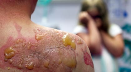 Las lesiones provocadas por el fuego pueden ser críticas