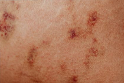 Las manchas en la piel pueden señalar una enfermedad (Foto Pexels)