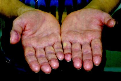 Las manos de Ibar Pérez Corradi, con las yemas de sus dedos melladas para dificultar su identificación mediante huellas dactilares