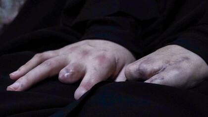 Las manos de Nayfe resultaron gravemente heridas en el ataque del buscapersonas