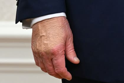 Las manos hinchadas de Trump, bajo escrutinio