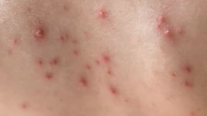 Las marcas de la varicela