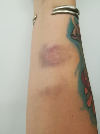 Las marcas de las agresiones en el brazo de Valeria