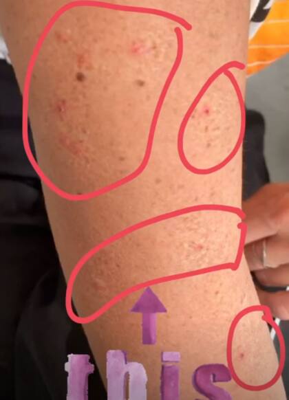 Las pulgas dejaron su marca en el brazo de Barbie Simons