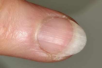 Las rayas de las uñas pueden significar diferentes afecciones en el organismo, conocé cuáles