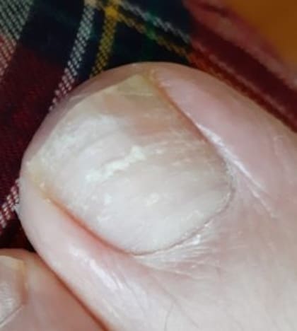 Las rayas horizontales pueden significar debilitamiento y falta de nutrientes