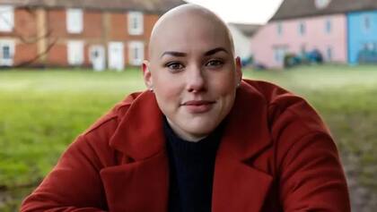 Laura Mathias comenzó a perder el cabello a los 12 años y ocultó su condición durante 17 años