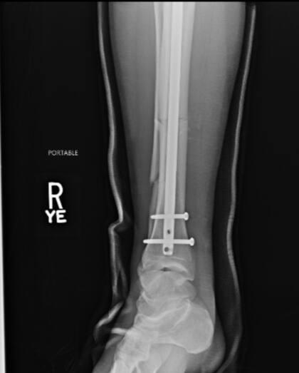 Le colocaron una placa de titanio en la tibia