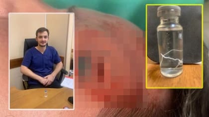 Le extrajeron un parásito de 15 centímetros y lo pusieron en exhibición