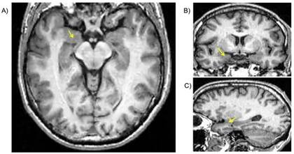 Localización de la amígdala en imágenes de resonancia magnética estructural (mostrada por las flechas amarillas). A) corte axial; B) corte coronal y C) corte sagital