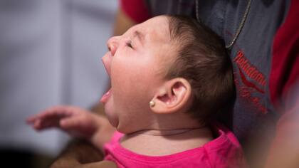 Los bebés que nacen con microcefalia