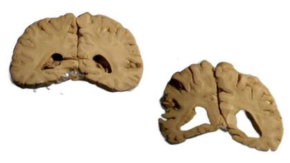 Los cerebros de quienes sufrieron de Alzheimer son más livianos, porque las células mueren y se hacen huecos. (Izq. cerebro sano de monja de 90 años; der. cerebro de monja de 89 años con Alzheimer)