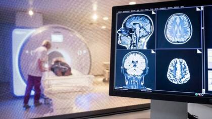 Los daños en el cerebro también han sido documentados en pacientes con Covid-19