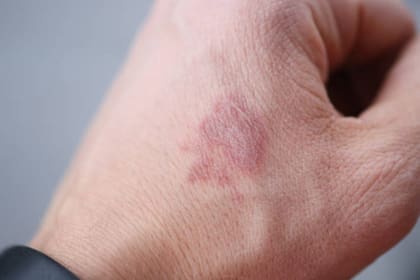 Los dermatólogos indican qué señales hay que prestar atención Foto Pexels)