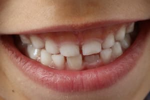 Los dientes amarillos pueden afectar la confianza y generar problemas de salud