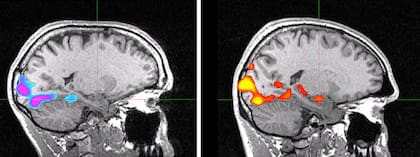 Los escaneos muestran el cerebro de Honnold (izquierda) y el del sujeto de control (derecha). El punto de la imagen donde se cruzan las líneas blancas marca la amígdala; cuando ambos escaladores miraban las mismas imágenes, la amígdala del individuo de control desprendía un color rojo/anaranjado, mientras que la de Honnold permanecía sin mostrar actividad alguna ni desprender color