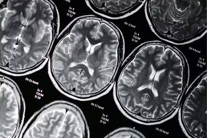 Los escáneres cerebrales pueden ayudar a investigar cómo responden las personas a las recompensas