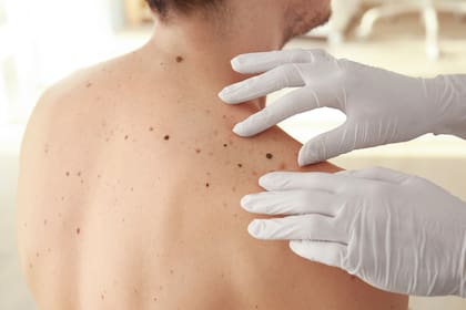Cáncer de piel: ya está disponible la vacuna argentina para tratar el melanoma de alto riesgo