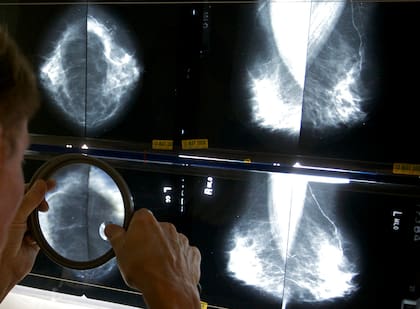 Los estudios preventivos del cáncer de mama pueden reducir entre un 28% y un 30% la cantidad de muertes por esa enfermedad