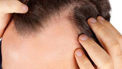 Caída del cabello: los factores pueden ser de diferentes orígenes