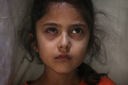 Muneefa Nazir, de seis años, una niña de Cachemira cuyo ojo derecho fue golpeado por una bola de mármol disparada presuntamente por soldados paramilitares indios