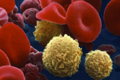 Las leucemias son una enfermedad de la médula ósea