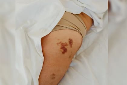 Los hematomas pueden aparecer por diversos motivos (Foto Pexels)