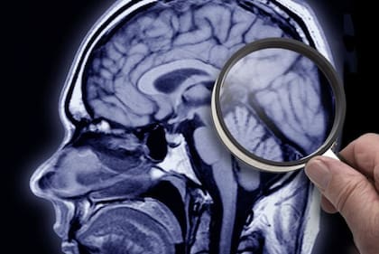 Los investigadores de la Universidad de Oxford compararon los factores de riesgo modificables de demencia