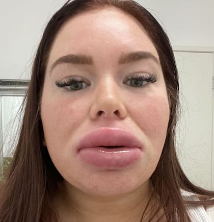 Los labios de Adriana sufrieron una reacción alérgica al disolvente