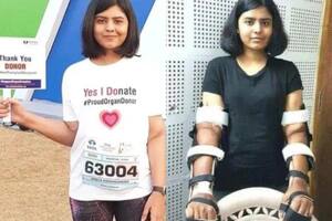La dura historia de la joven a la que le hicieron un doble trasplante de brazos