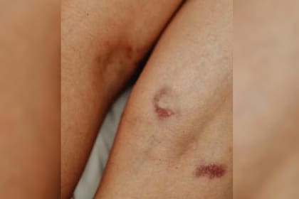 Los moretones pueden aparecer por la deficiencia de una vitamina (Foto Pexels)
