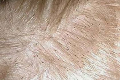 Los pediculicidas han ido perfeccionándose hasta encontrar formas de combatirlo de manera no tóxica