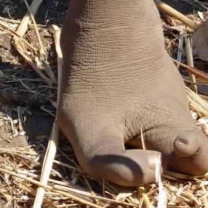 Los pies de algunos de los pobladores de Vadoma con esta alteración no pueden llevar calzado, pero son de mucha ayuda para trepar árboles